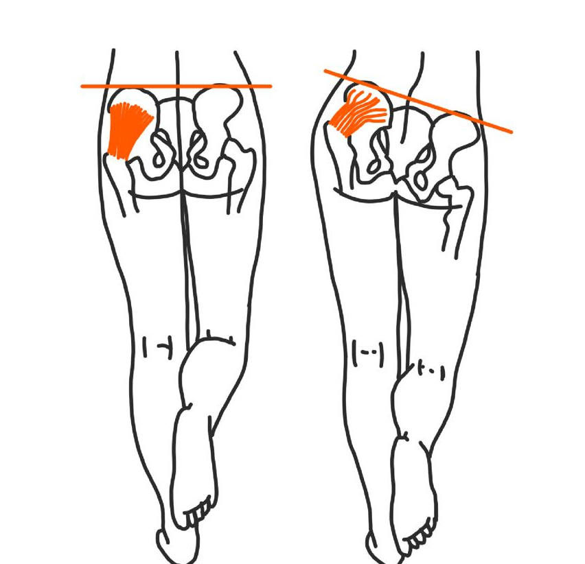 Trendelenburg Duchenne